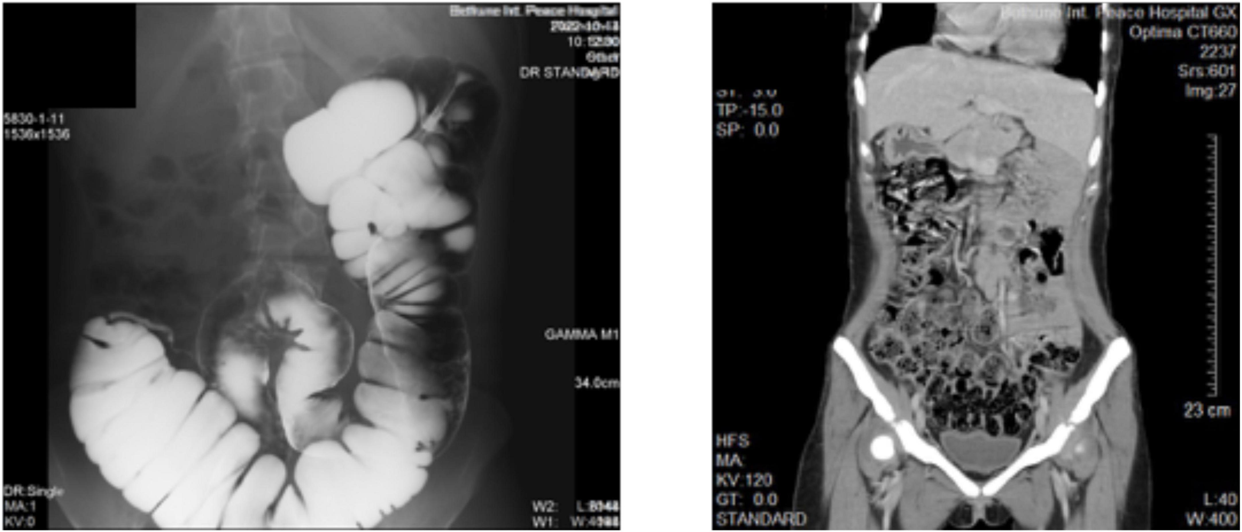 An adult female patient with single atrium and <mark class="highlighted">single ventricle</mark> undergoing appendectomy: A case report